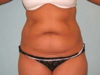 Abdominoplasty