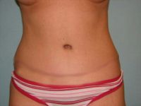 Abdominoplasty