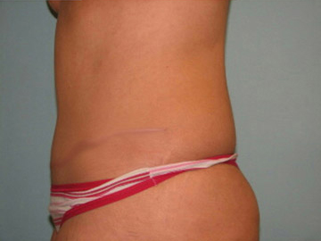 Abdominoplasty