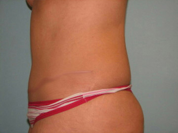 Abdominoplasty