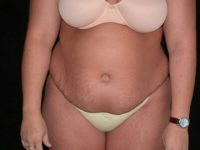 Abdominoplasty