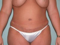 Abdominoplasty