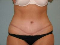 Abdominoplasty