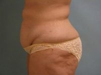 Abdominoplasty
