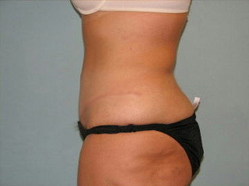 Abdominoplasty