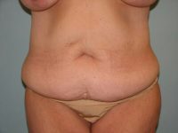 Abdominoplasty