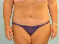 Abdominoplasty