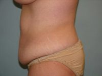 Abdominoplasty