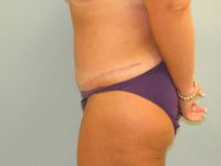 Abdominoplasty