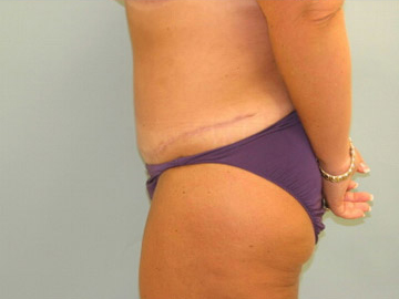 Abdominoplasty