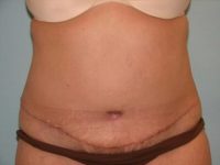 Abdominoplasty