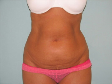 Abdominoplasty