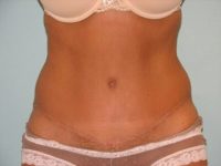 Abdominoplasty