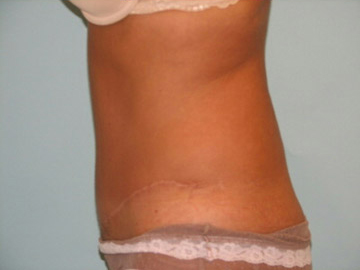 Abdominoplasty