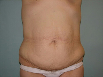 Abdominoplasty