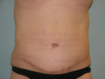 Abdominoplasty