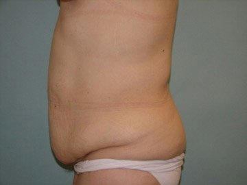 Abdominoplasty