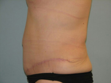 Abdominoplasty