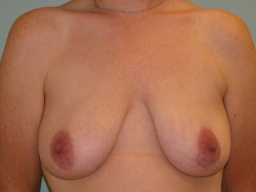 Augmentation & Mastopexy