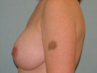 Augmentation & Mastopexy