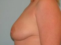 Augmentation & Mastopexy