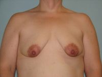 Augmentation & Mastopexy