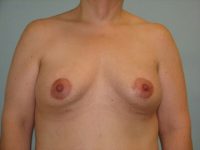 Augmentation & Mastopexy