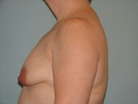 Augmentation & Mastopexy