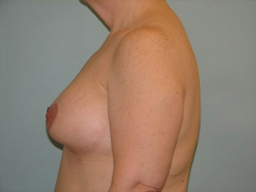 Augmentation & Mastopexy