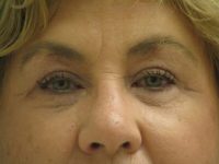 Blepharoplasty