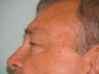 Blepharoplasty