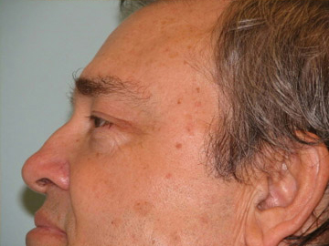 Blepharoplasty