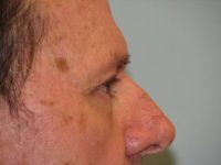 Blepharoplasty