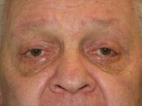 Blepharoplasty