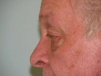 Blepharoplasty