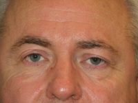 Blepharoplasty