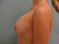 Breast Augmentation