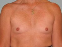 Breast Augmentation