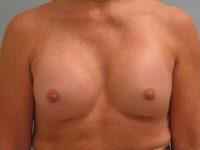 Breast Augmentation