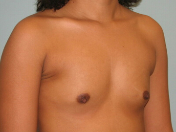 Breast Augmentation