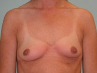 Breast Augmentation