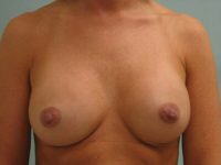 Breast Augmentation