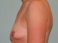Breast Augmentation