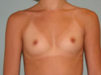 Breast Augmentation