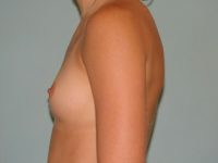 Breast Augmentation