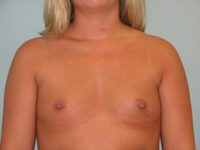 Breast Augmentation