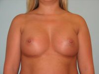 Breast Augmentation