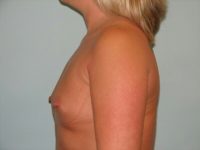 Breast Augmentation