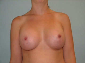 Breast Augmentation