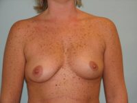 Breast Augmentation